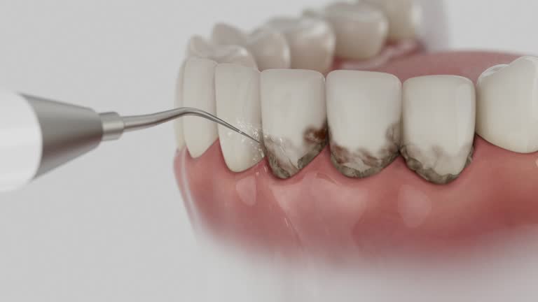 Trusted Wisdom Tooth Removal service in Brookdale, SC - Dentist Open Now